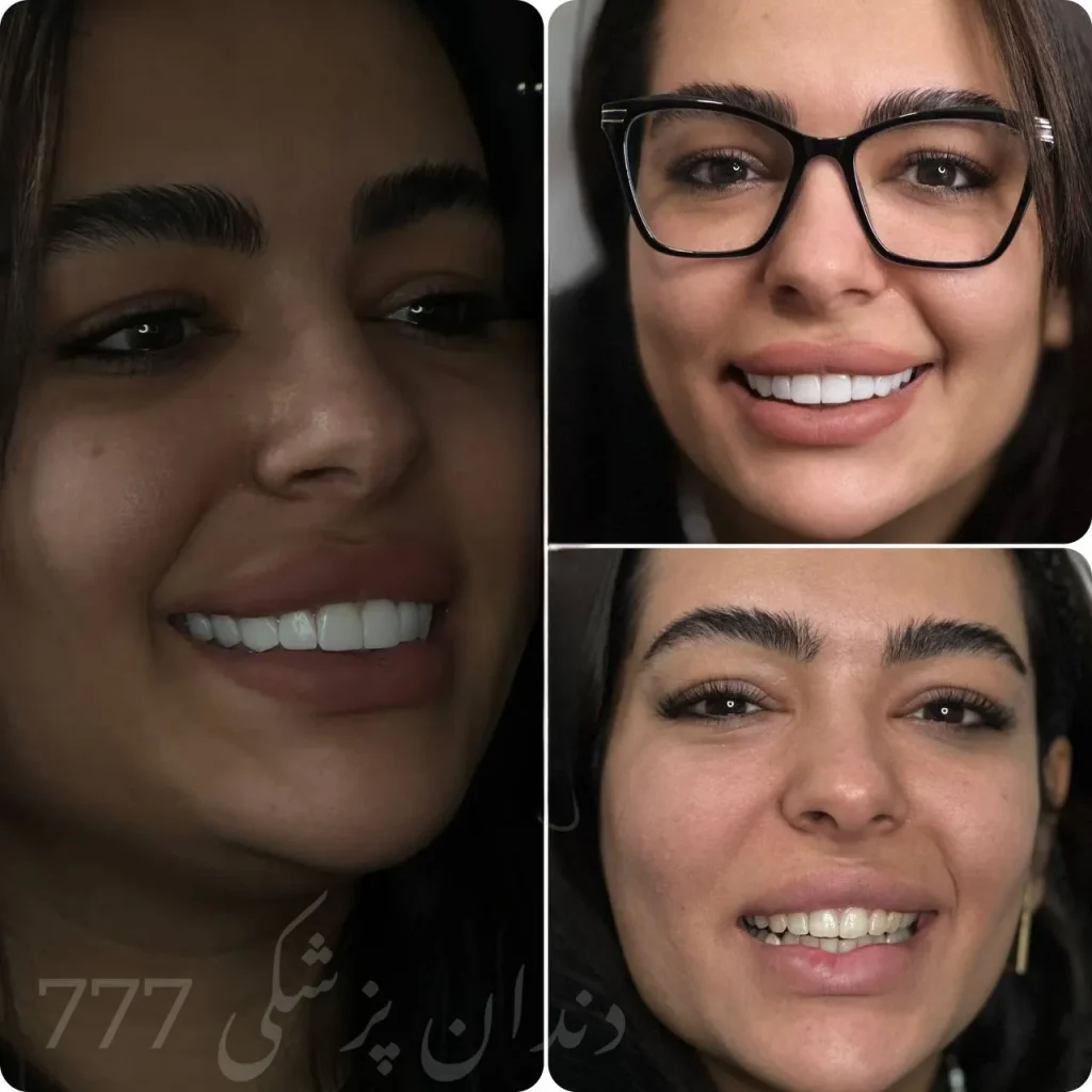 نمونه کار کامپوزیت دندان در اندیشه