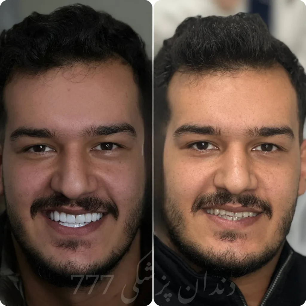نمونه کار کامپوزیت دندان در اندیشه