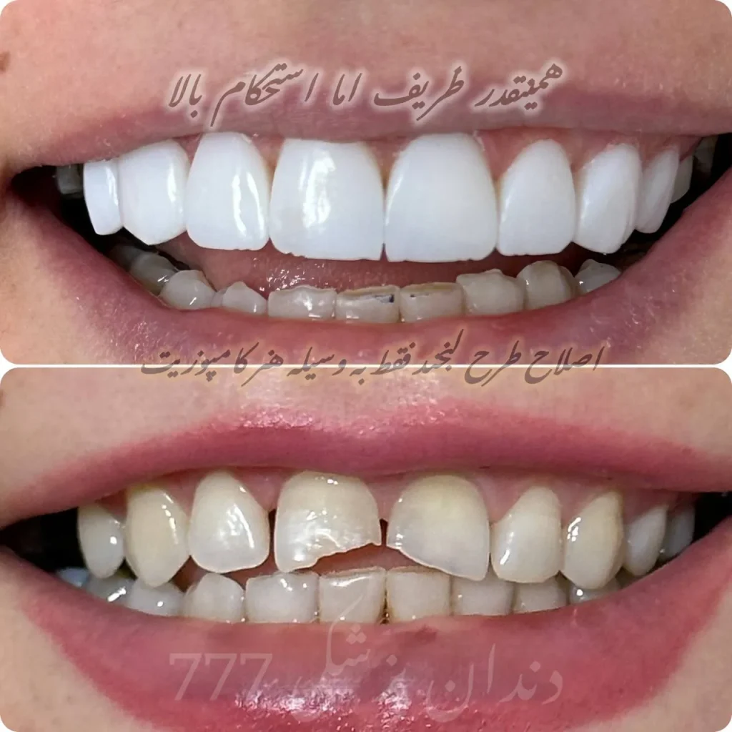 نمونه کار کامپوزیت دندان در اندیشه