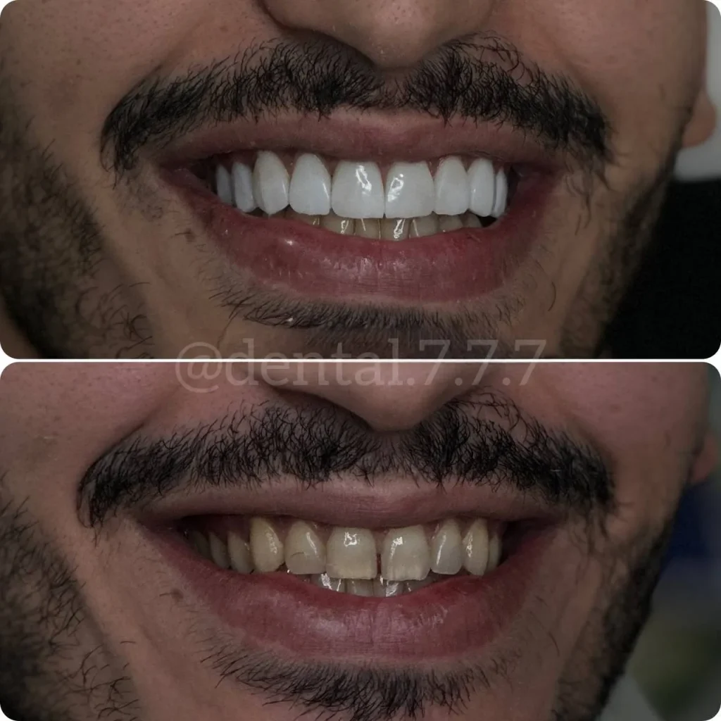 نمونه کار کامپوزیت دندان در اندیشه