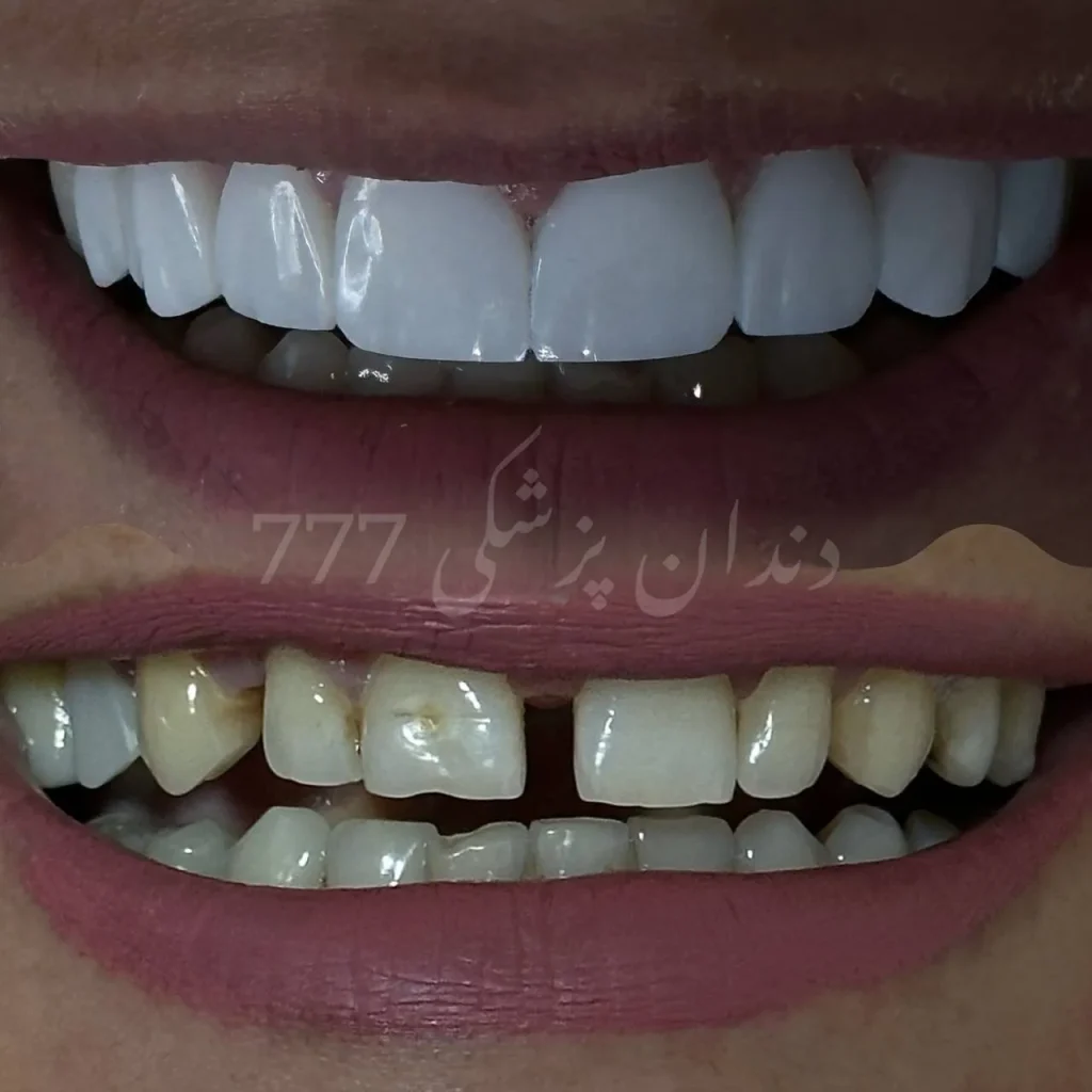 نمونه کار کامپوزیت دندان در اندیشه