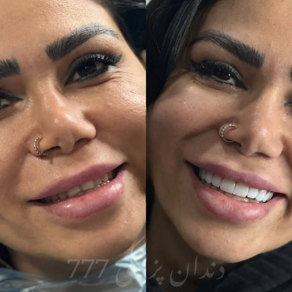 نمونه کار کامپوزیت دندان در اندیشه