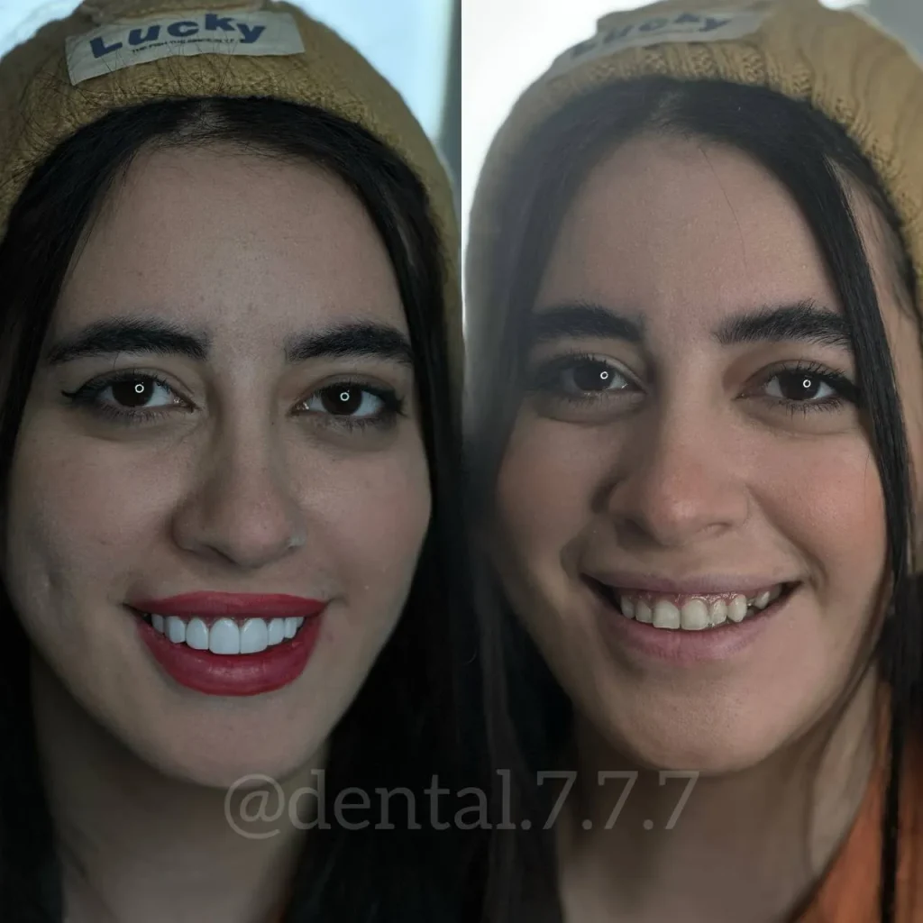 نمونه کار کامپوزیت دندان در اندیشه