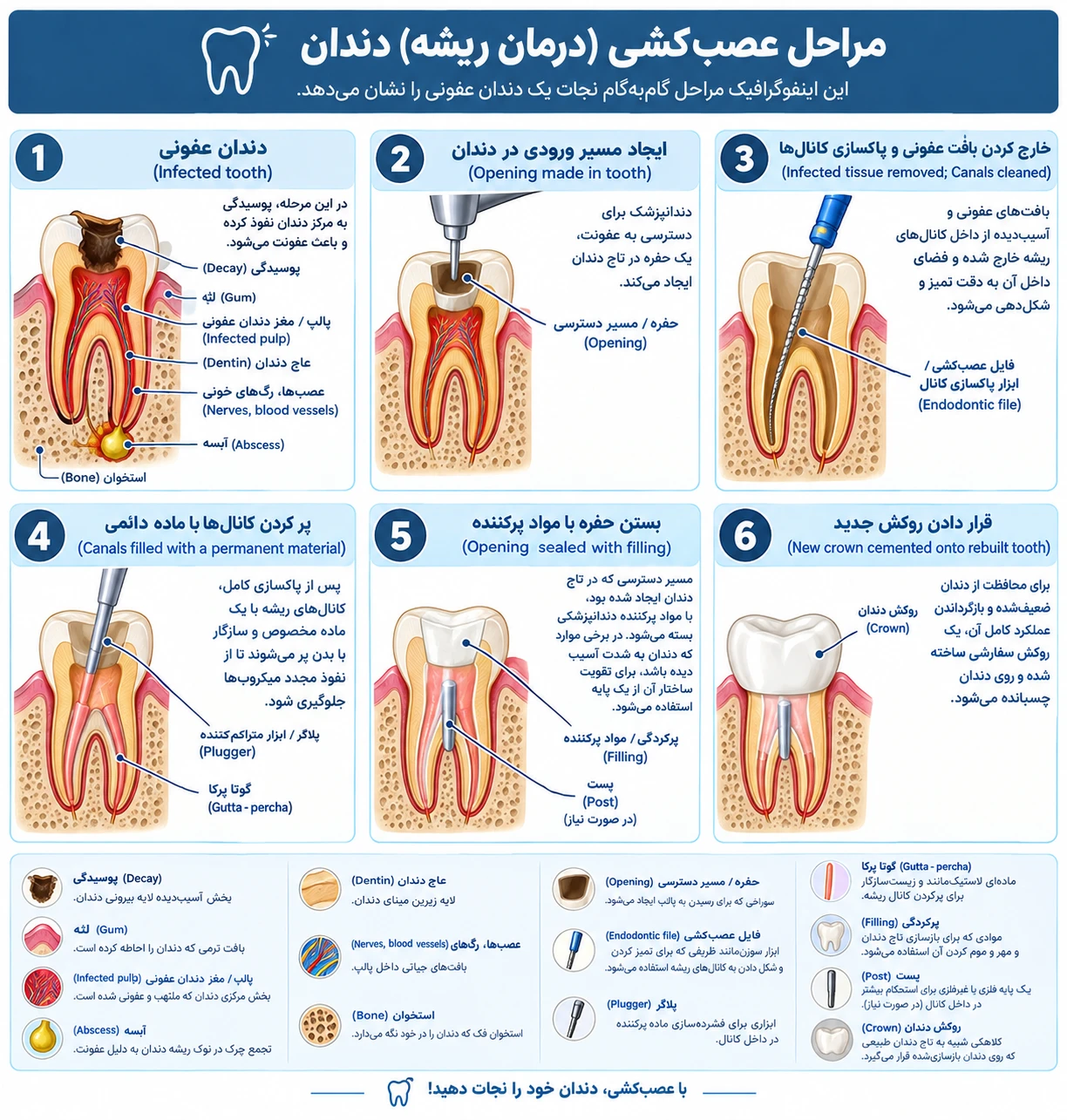 اینفوگرافیک مراحل عصب‌کشی یا درمان ریشه دندان