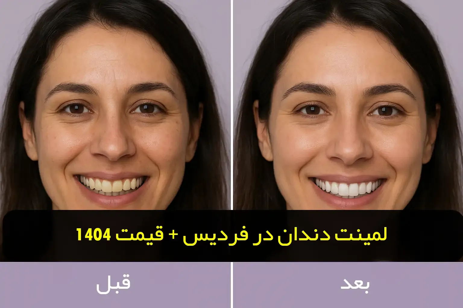 لمینت دندان در فردیس | قیمت، مراحل و بهترین دندانپزشک زیبایی