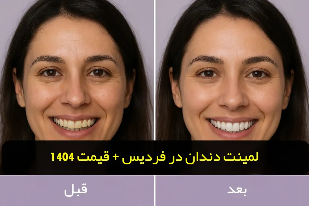 لمینت دندان در فردیس
